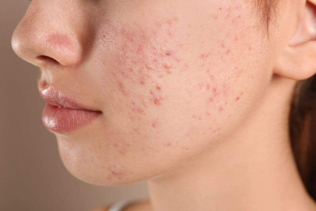 Acne Treatment